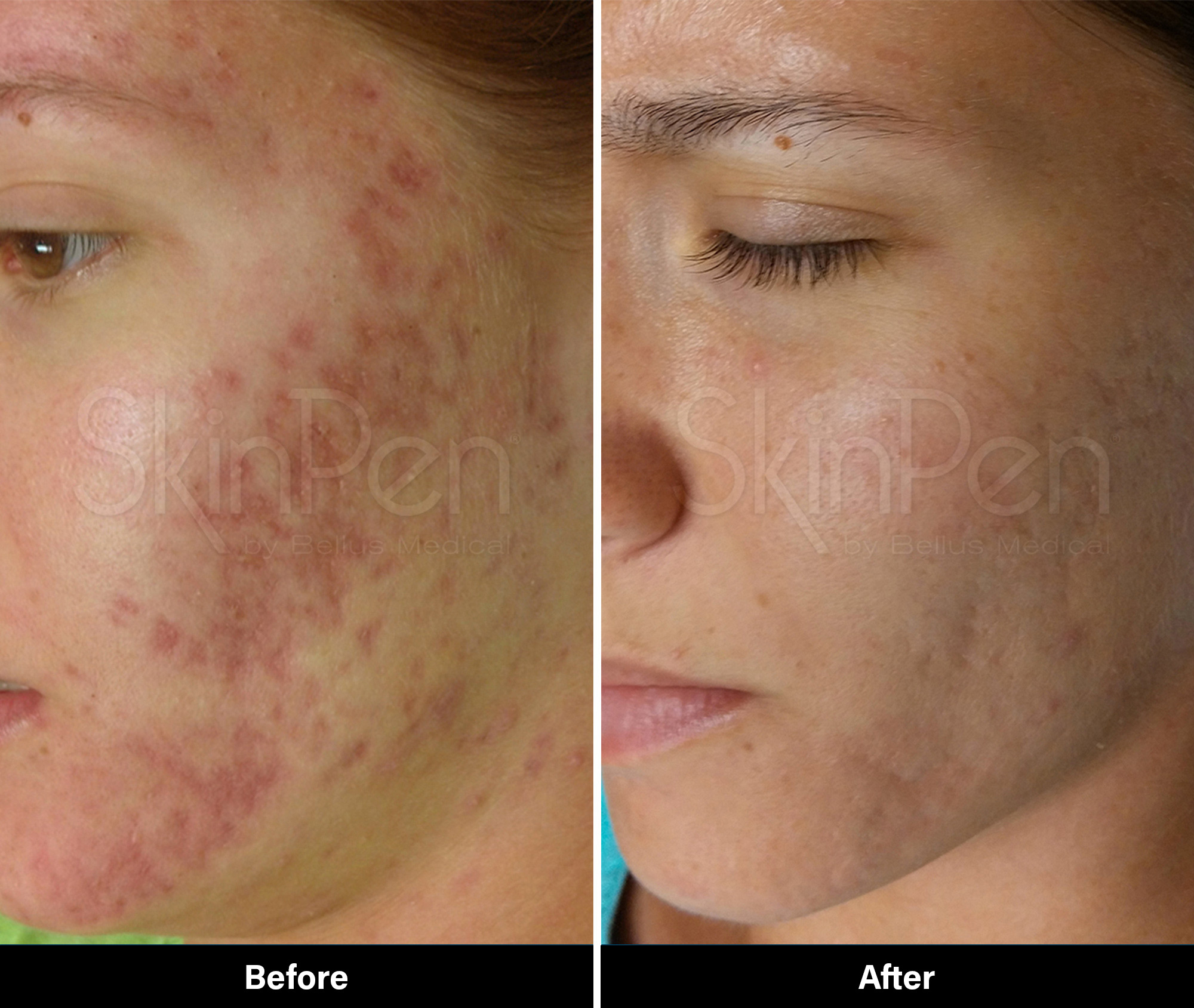 Acne Before and After