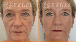 EZ-Gel Before/After woman in her 60's.