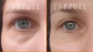 EZ-Gel Before/After for young woman