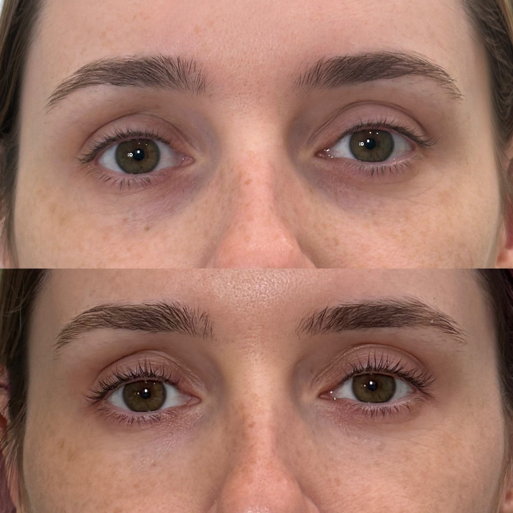 PRF Under-Eye Treatment Before/After