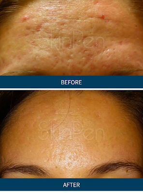 SkinPen PRP